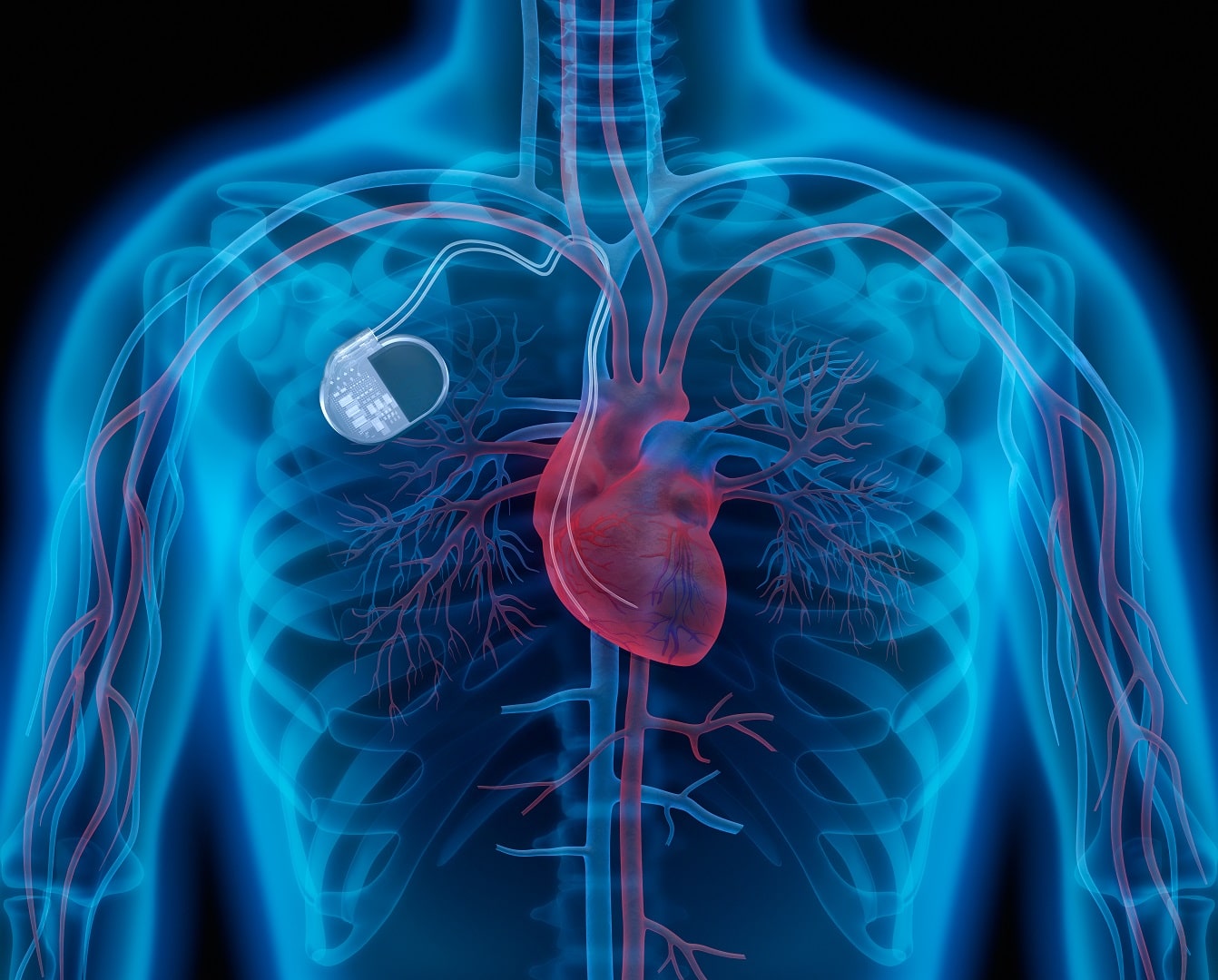 Iphone 12 kan de werking van een pacemaker verstoren